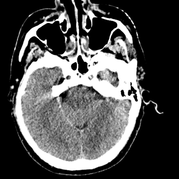 Basilar artery thrombosis (Radiopaedia 53351-59333 Axial non-contrast 46).jpg