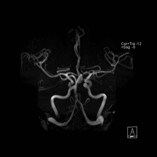 Basilar tip aneurysm (Radiopaedia 26504-26632 D 3).jpg