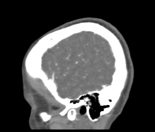 Basilar tip aneurysm with coiling (Radiopaedia 53912-60086 C 120).jpg