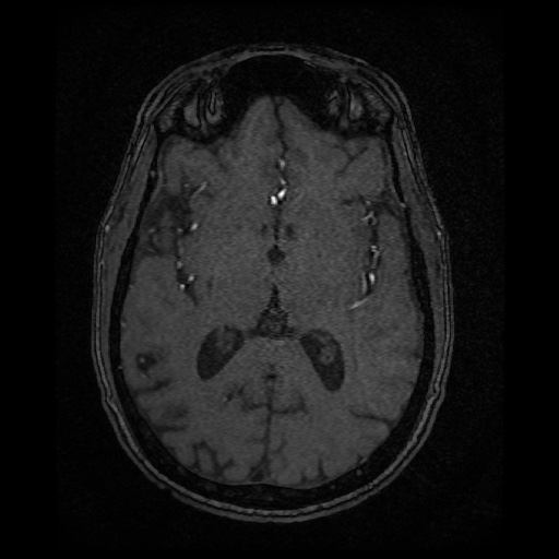 Basilar top and left middle cerebral artery aneurysm (Radiopaedia 61965-70031 Axial MRA 86).jpg