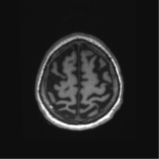 Behavioral variant frontotemporal dementia and late onset schizophrenia (Radiopaedia 52197-58083 Axial T1 5).png