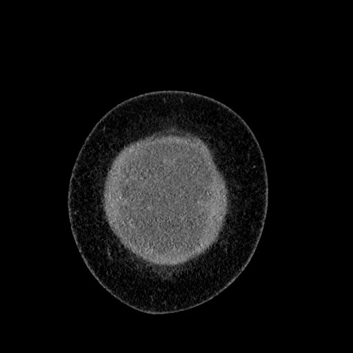 File:Benign leiomyoma with hydropic features (Radiopaedia 89250-106130 B 9).jpg