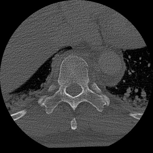 Benign post-traumatic pseudopneumoperitoneum (Radiopaedia 71199-81495 Axial bone window 133).jpg