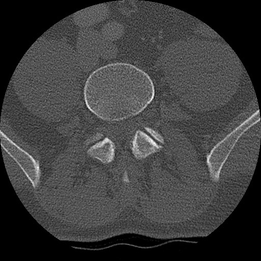 Benign post-traumatic pseudopneumoperitoneum (Radiopaedia 71199-81495 Axial bone window 262).jpg