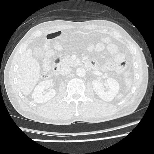 Benign post-traumatic pseudopneumoperitoneum (Radiopaedia 71199-81495 Axial lung window 80).jpg