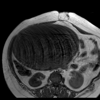 File:Benign seromucinous cystadenoma of the ovary (Radiopaedia 71065-81300 Axial T1 28).jpg