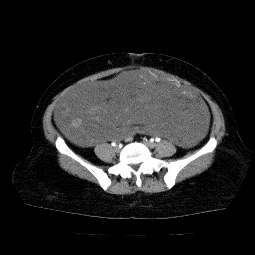 File:Benign spindle cell tumor - abdominopelvic (Radiopaedia 61300-69212 A 43).jpg