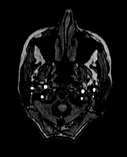 File:Berry aneurysm of the terminal internal carotid artery (Radiopaedia 88286-104918 Axial TOF 25).jpg