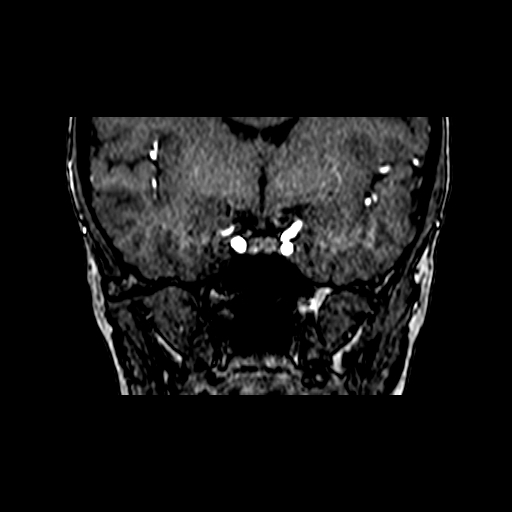 File:Berry aneurysm of the terminal internal carotid artery (Radiopaedia 88286-104918 Coronal TOF 40).jpg