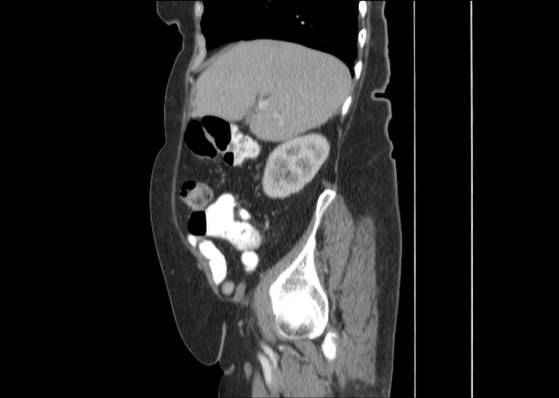 Bicameral celiacomesenteric aneurysm (Radiopaedia 55766-62327 B 17).jpg
