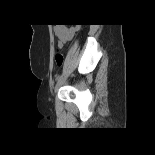 File:Bicornuate uterus- on MRI (Radiopaedia 49206-54296 A 18).jpg