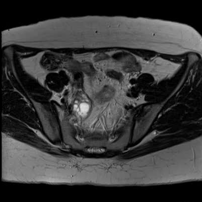 File:Bicornuate uterus (MRI) (Radiopaedia 49206-54297 Axial 31).png