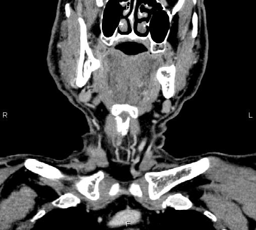 File:Bilateral Warthin tumors (Radiopaedia 84034-99263 C 15).jpg