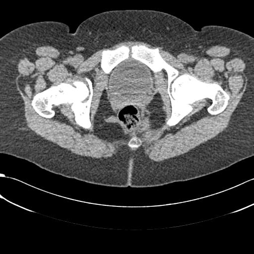 Bilateral acetabular protrusion with pincer type femoro-acetabular impingement (Radiopaedia 30134-30733 AXIAL SOFT THIN 61).jpg