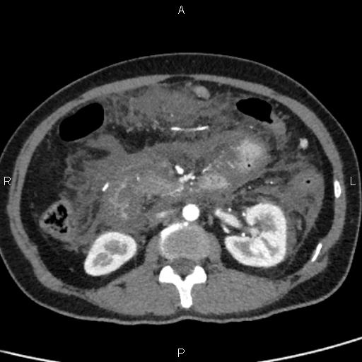 Bilateral adrenal gland hyperenhancement in pancreatitis (Radiopaedia 86642-102753 B 63).jpg