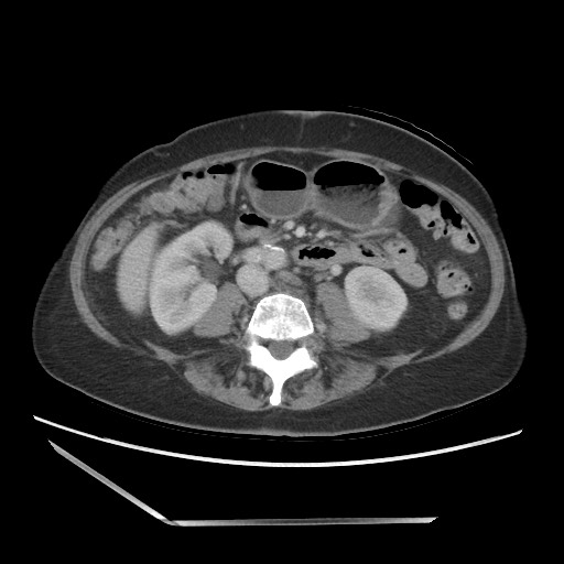 Bilateral adrenal granulocytic sarcomas (chloromas) (Radiopaedia 78375-91007 A 65).jpg