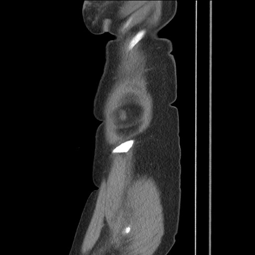 Bilateral adrenal granulocytic sarcomas (chloromas) (Radiopaedia 78375-91007 C 21).jpg