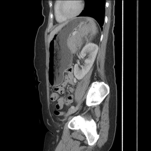 Bilateral adrenal granulocytic sarcomas (chloromas) (Radiopaedia 78375-91007 C 95).jpg