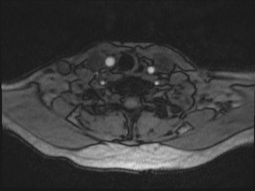 Bilateral carotid body tumors and right glomus jugulare tumor (Radiopaedia 20024-20060 Axial MRA 197).jpg