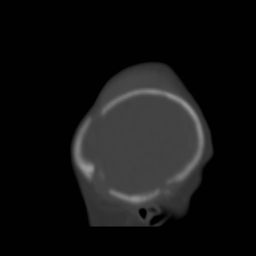 File:Bilateral cephalohematomas and subdural hematomas (Radiopaedia 26778-26929 Sagittal bone window 37).jpg
