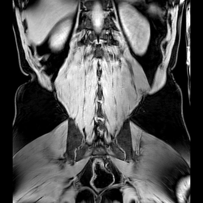 Bilateral conjoined nerve roots at different levels (Radiopaedia 73312-84063 Coronal WE 45).jpg