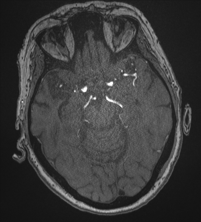 Bilateral fetal posterior communicating arteries (Radiopaedia 41286-44102 Axial MRA 78).png