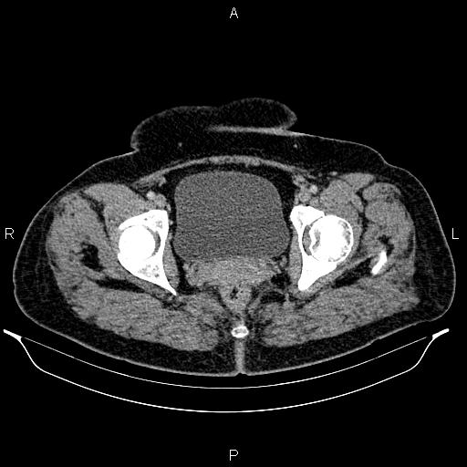 File:Bilateral ovarian dermoid cysts (Radiopaedia 85785-101603 A 102).jpg