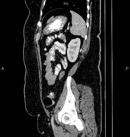 Bilateral ovarian dermoid cysts (Radiopaedia 85785-101603 D 74).jpg