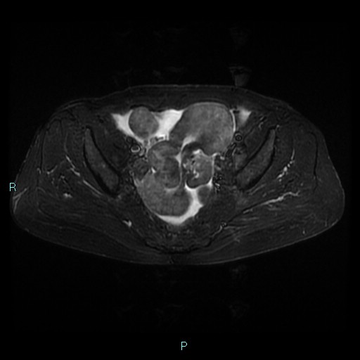 File:Bilateral ovarian fibroma (Radiopaedia 44568-48293 Axial STIR 13).jpg