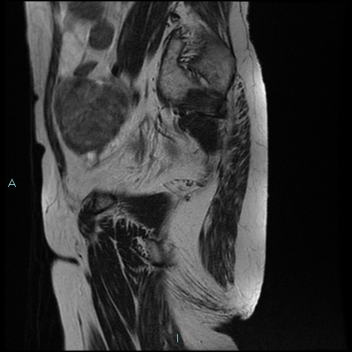 File:Bilateral ovarian fibroma (Radiopaedia 44568-48293 Sagittal T2 8).jpg