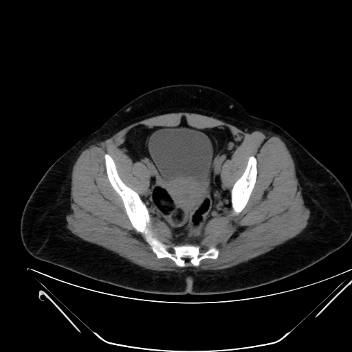 File:Bilateral ovarian mature cystic teratomas (Radiopaedia 79373-92457 Axial non-contrast 64).jpg