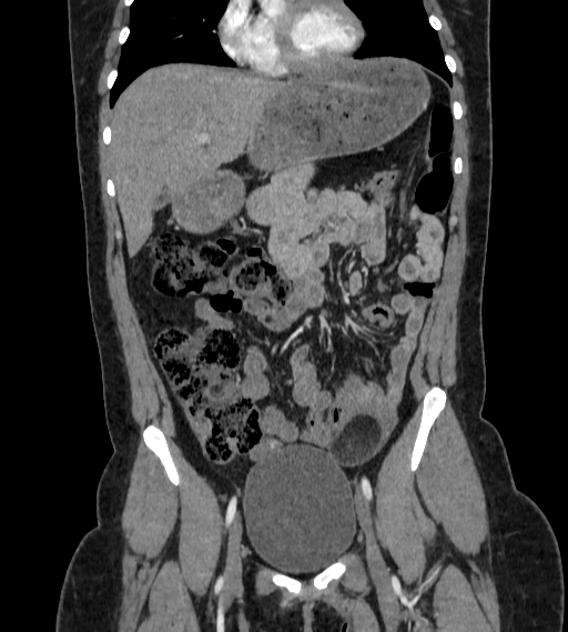 Bilateral ovarian mature cystic teratomas (Radiopaedia 79373-92457 B 18).jpg