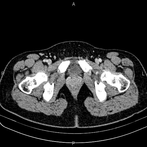Bilateral ovarian teratoma (Radiopaedia 83131-97503 Axial With contrast 78).jpg