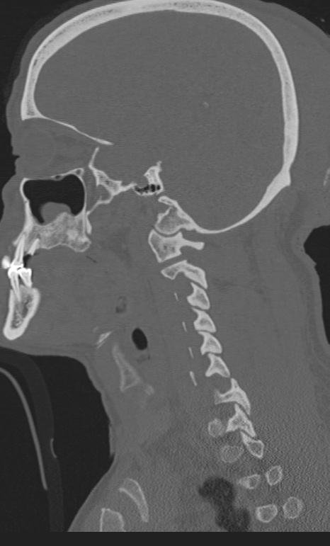 Bilateral perched facet joint (Radiopaedia 63149-71669 Sagittal bone window 53).jpg