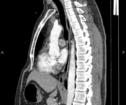 Bilateral pulmonary AVM (Radiopaedia 83134-97505 D 62).jpg