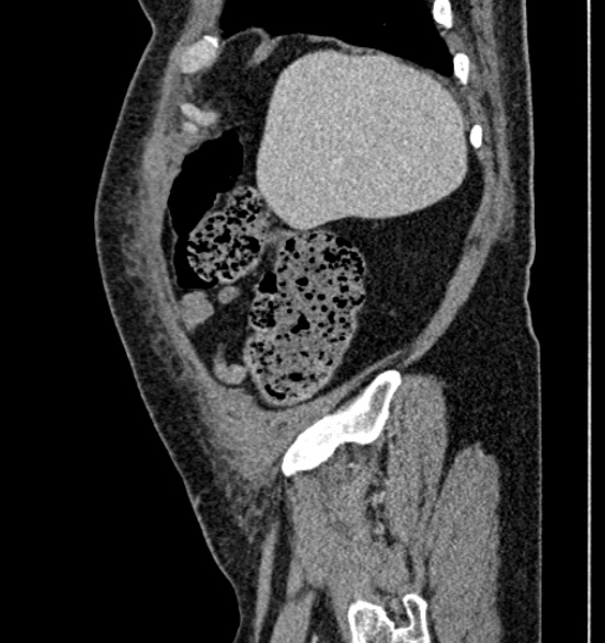 Bilateral rectus sheath hematomas (Radiopaedia 50778-56252 B 15).jpg