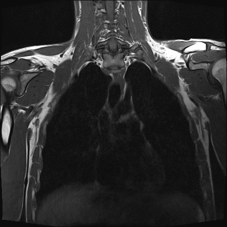 File:Bilateral spinoglenoid notch ganglion cysts (Radiopaedia 29577-30082 Coronal T1 15).jpg
