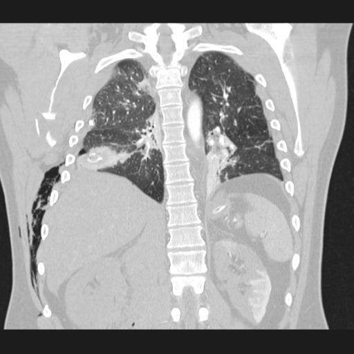 Bilateral traumatic renovascular injury (Radiopaedia 32051-32995 Coronal lung window 56).jpg