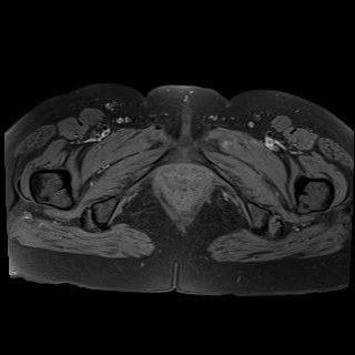 Bilateral tubo-ovarian abscesses (Radiopaedia 58635-65829 Axial T1 fat sat 45).jpg
