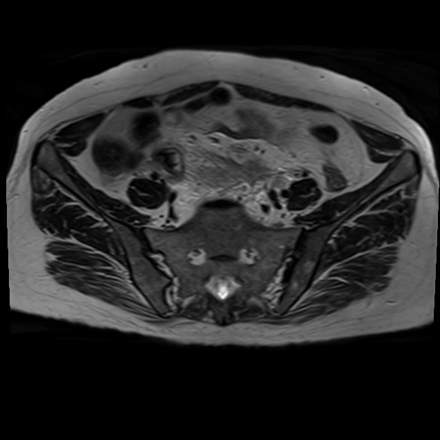 Bilateral tubo-ovarian abscesses (Radiopaedia 58635-65829 Axial T2 9).jpg