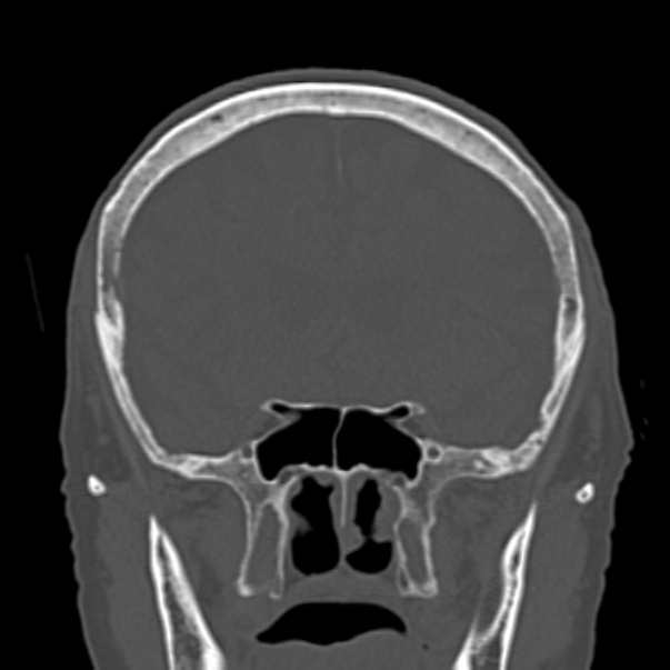 Biparietal osteodystrophy (Radiopaedia 46109-50463 Coronal bone window 42).jpg