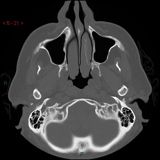 Bisphosphonate-related osteonecrosis of the jaw (Radiopaedia 54147-60329 Axial bone window 15).jpg