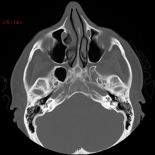 Bisphosphonate-related osteonecrosis of the jaw (Radiopaedia 54147-60329 Axial bone window 8).jpg