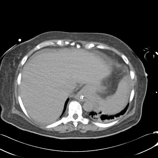Bladder rupture post renal biopsy (Radiopaedia 30863-31572 Axial non-contrast 12).jpg