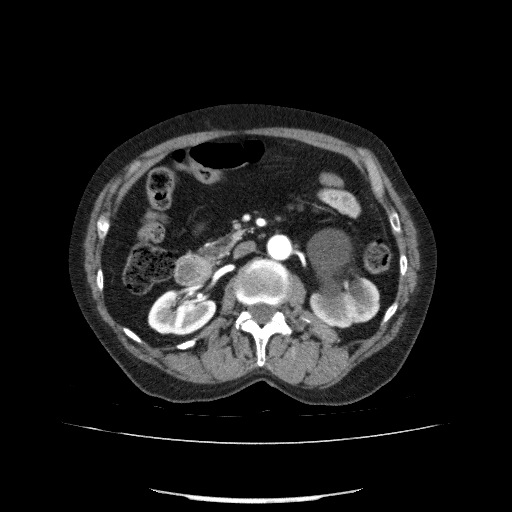 Bladder tumor detected on trauma CT (Radiopaedia 51809-57609 A 106).jpg