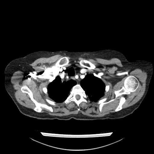 File:Bladder tumor detected on trauma CT (Radiopaedia 51809-57609 A 17).jpg