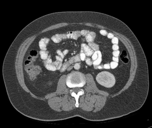 File:Bleeding duodenal ulcer and adenomyomatosis of gallbladder (Radiopaedia 61834-69861 A 64).jpg