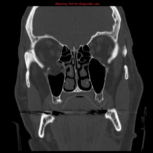 File:Blowout fracture with inferior rectus entrapment (Radiopaedia 12418-12673 Coronal bone window 10).jpg