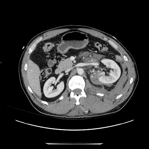 Blunt abdominal trauma with solid organ and musculoskelatal injury with active extravasation (Radiopaedia 68364-77895 A 54).jpg