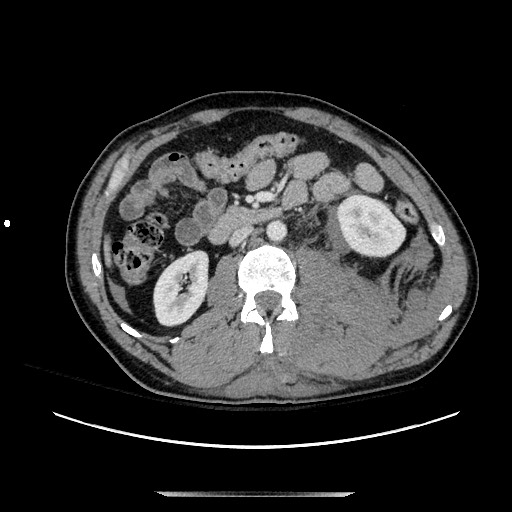 Blunt abdominal trauma with solid organ and musculoskelatal injury with active extravasation (Radiopaedia 68364-77895 A 67).jpg